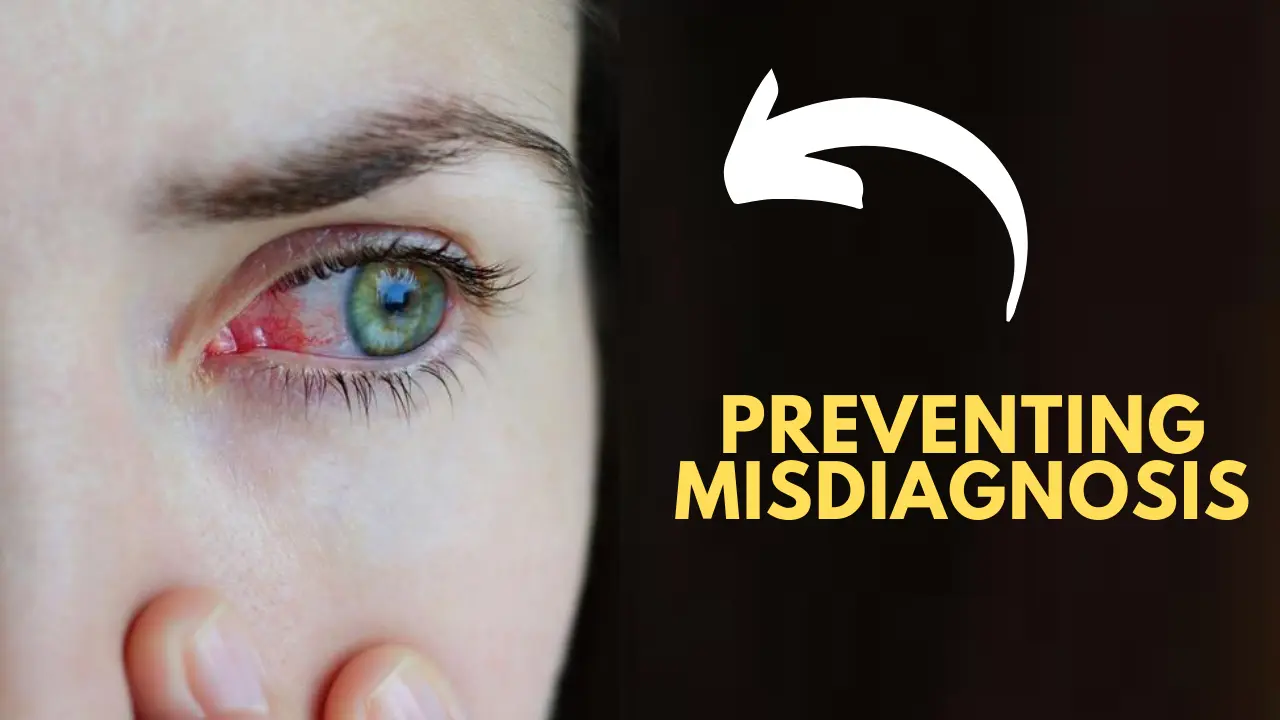 What is commonly misdiagnosed as pink eye